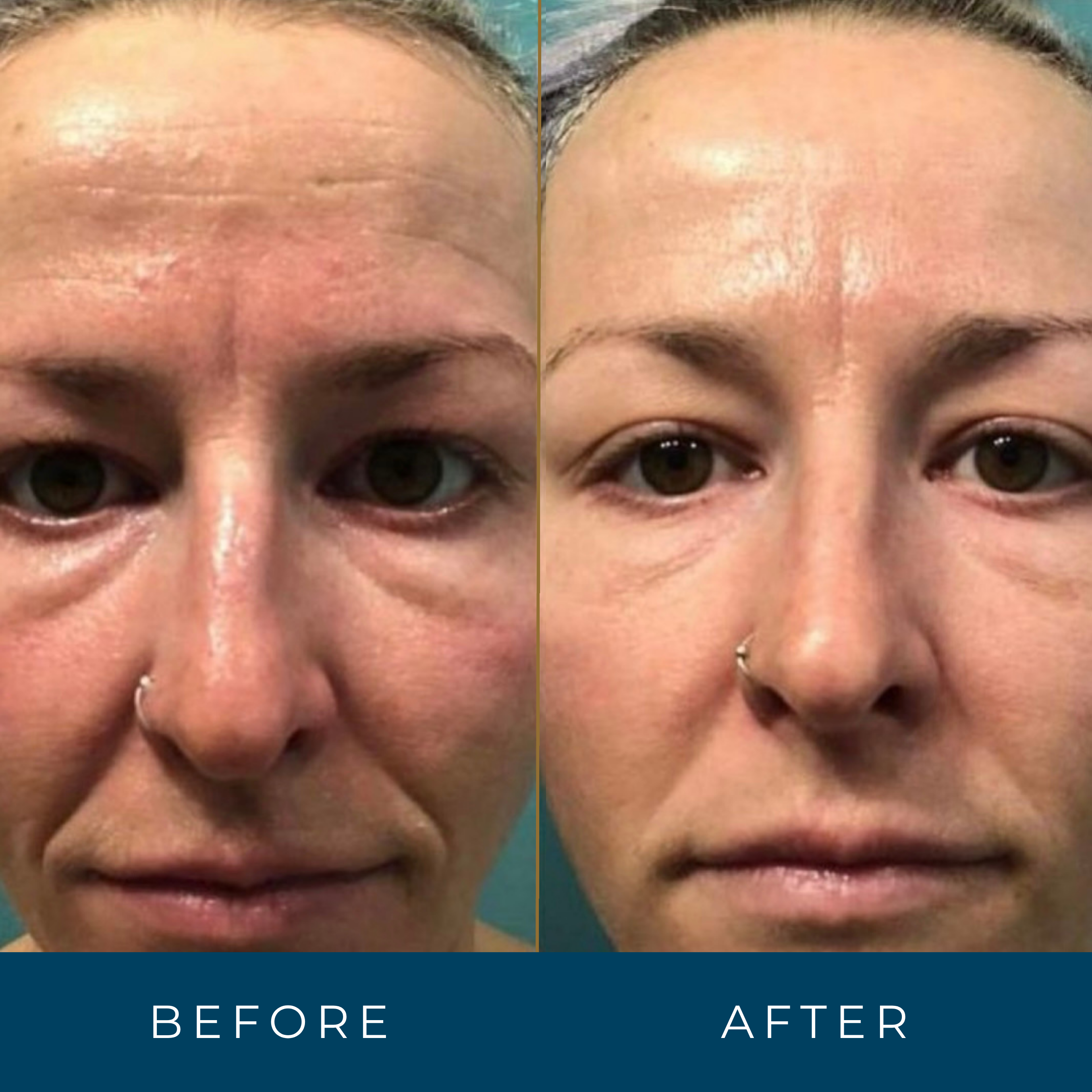 Retinal Face Serum Anti-Aging Vitamin A Wrinkle Reducer