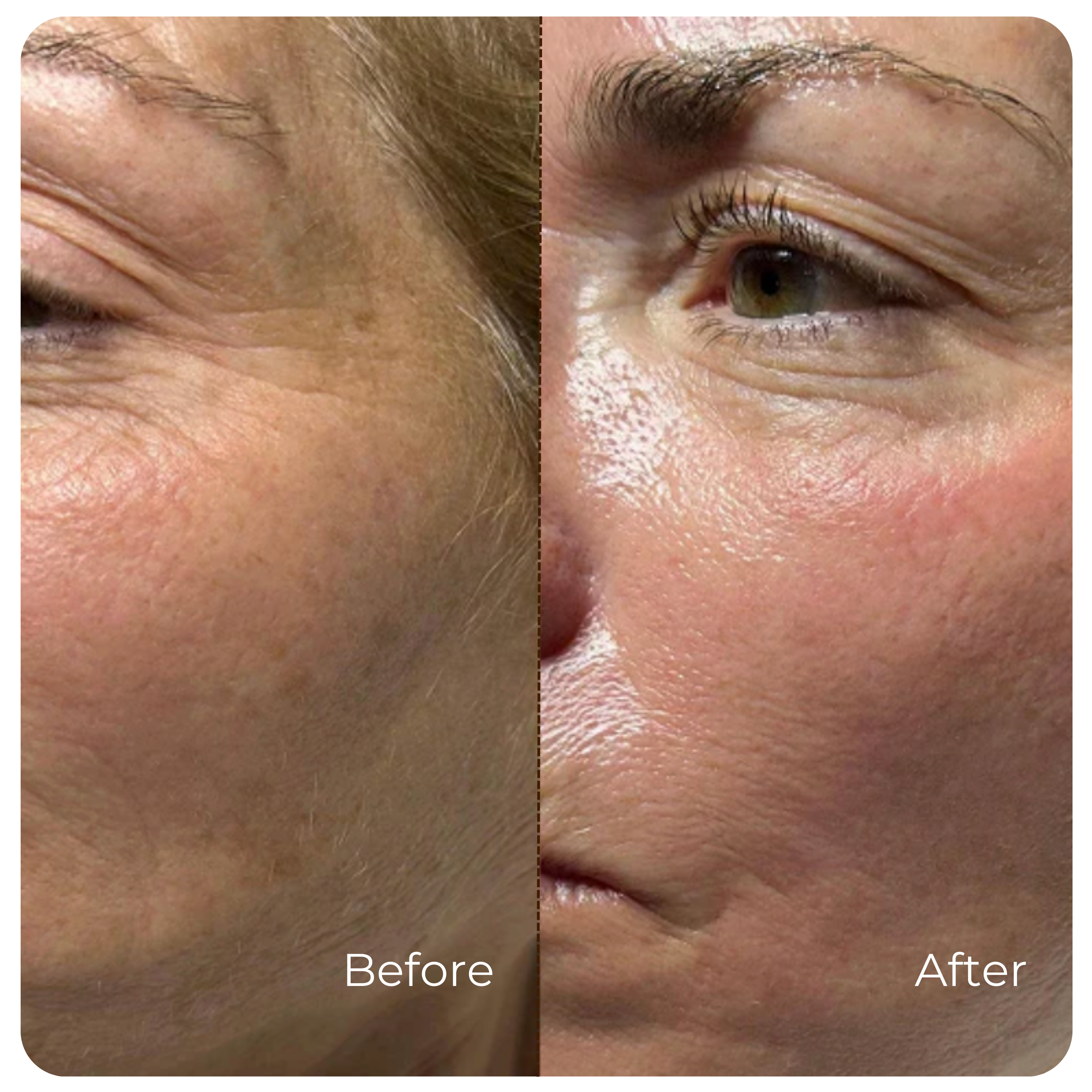 AlpaSkin™ Korean Ampoule Serum — Without a Single Needle