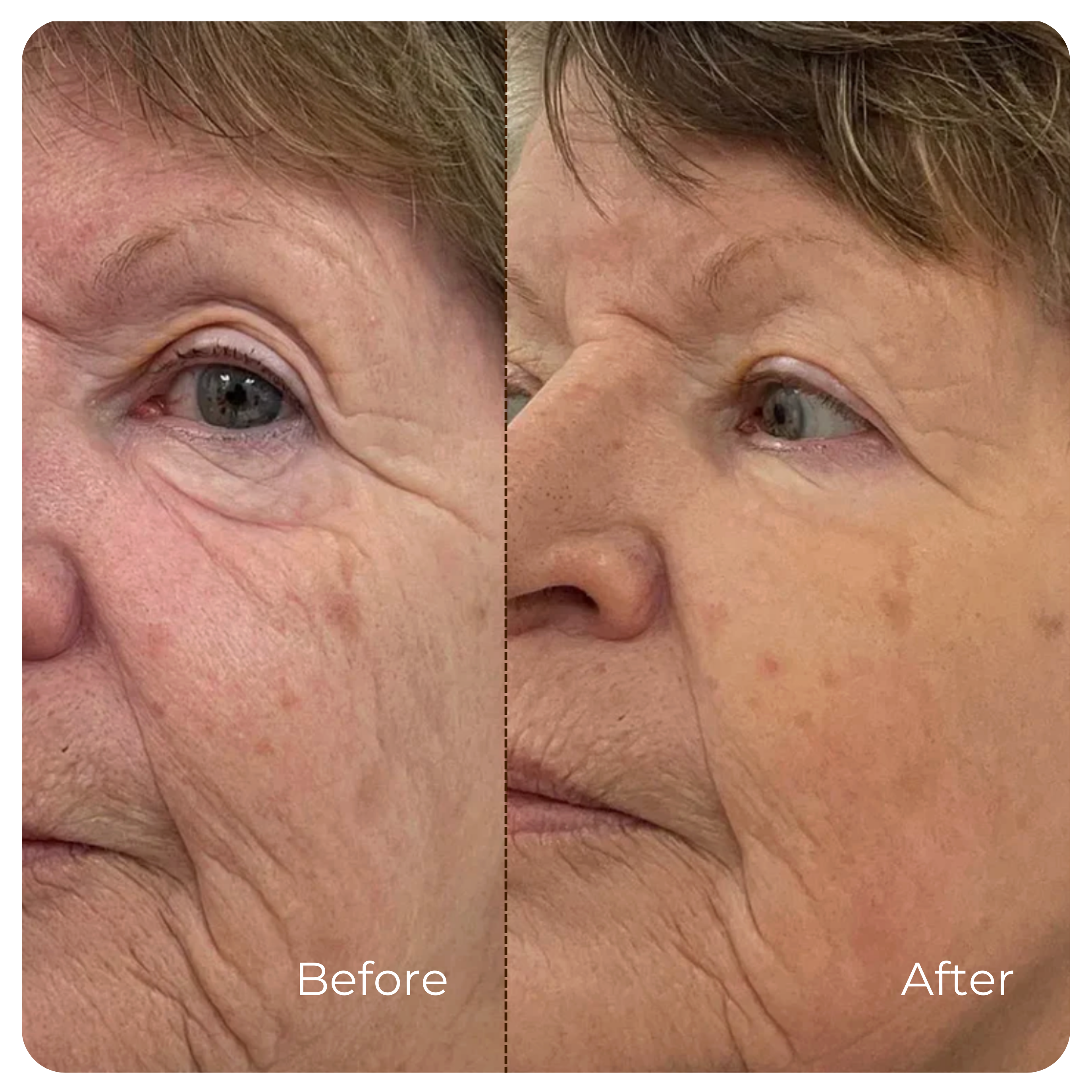 AlpaSkin™ Korean Ampoule Serum — Without a Single Needle