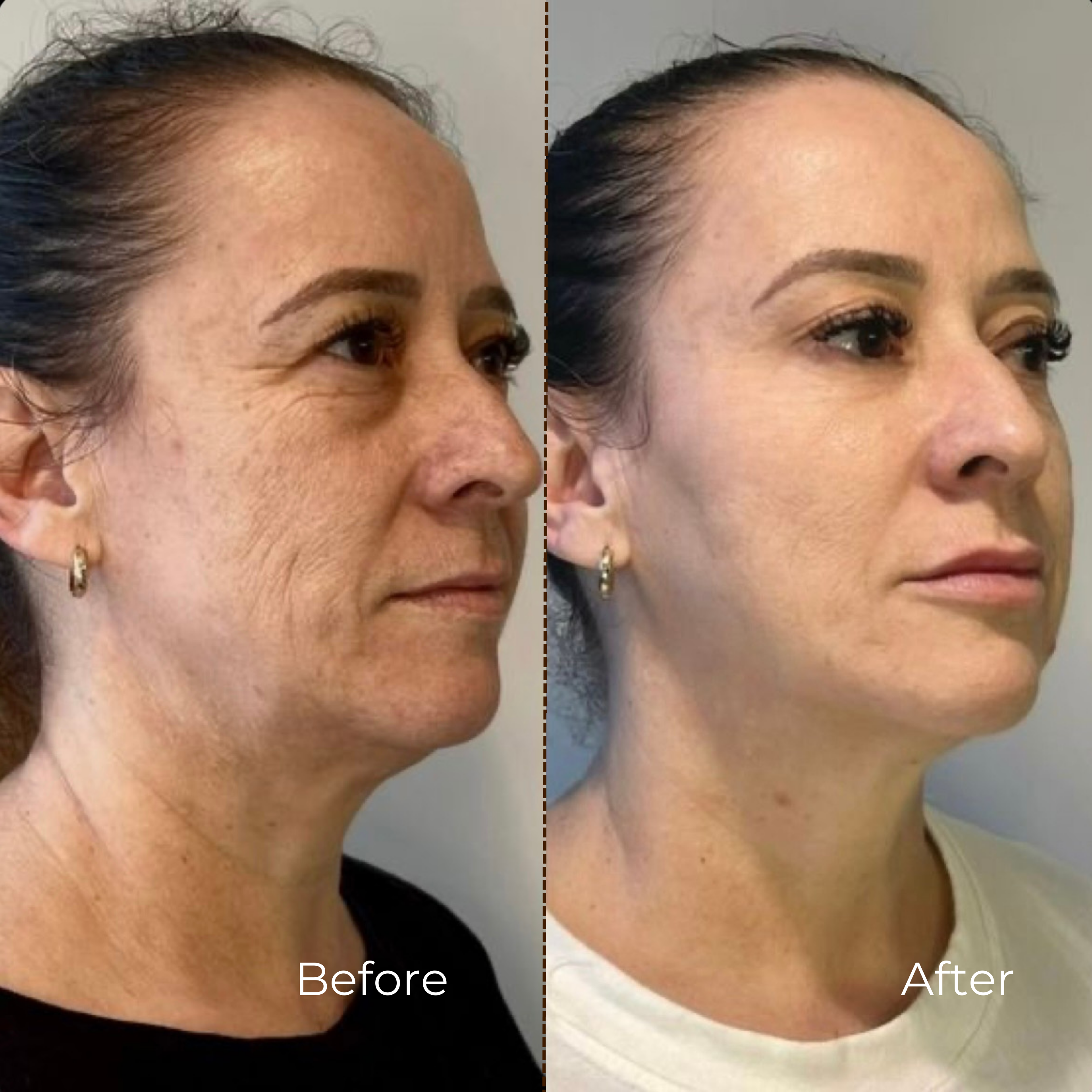 AlpaSkin™ Collagen Lift Cream-Serum