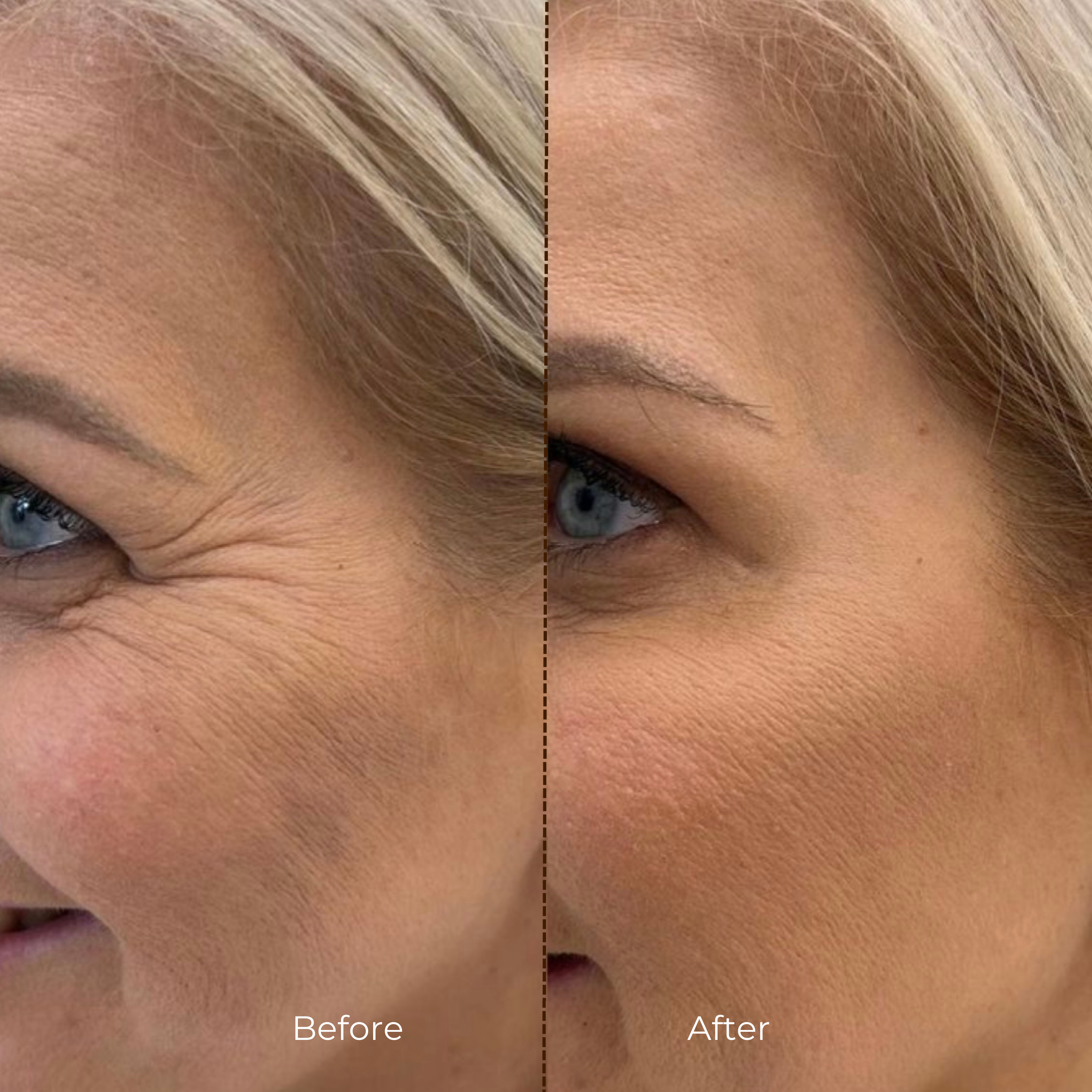 AlpaSkin™ Vita-A Retinal Shot