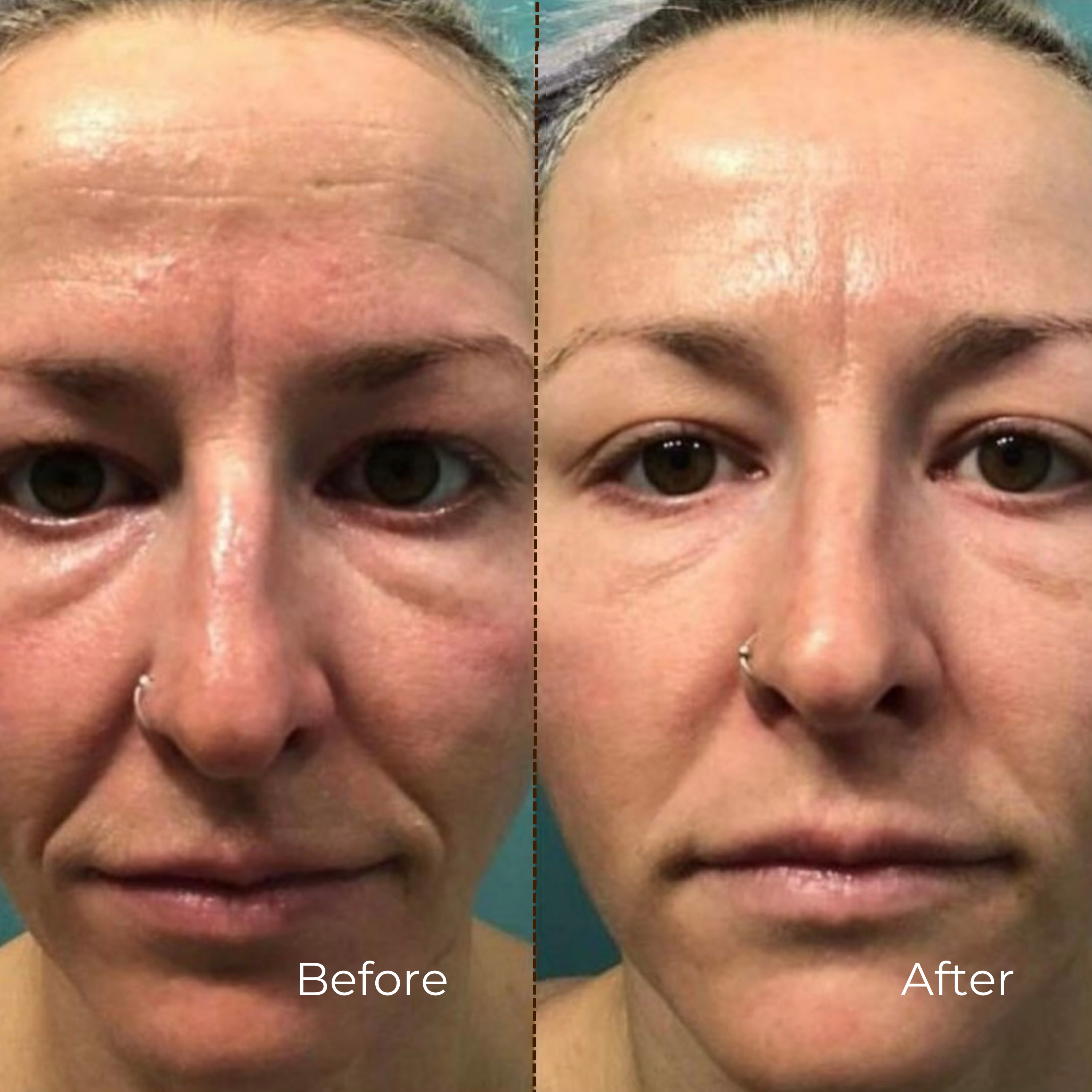 AlpaSkin™ Vita-A Retinal Shot