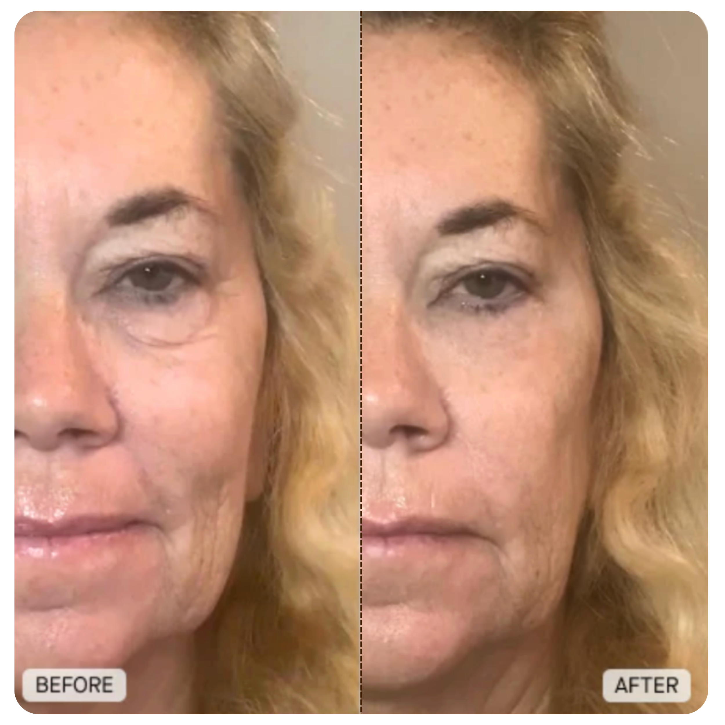 AlpaSkin™ Korean Ampoule Serum — Without a Single Needle