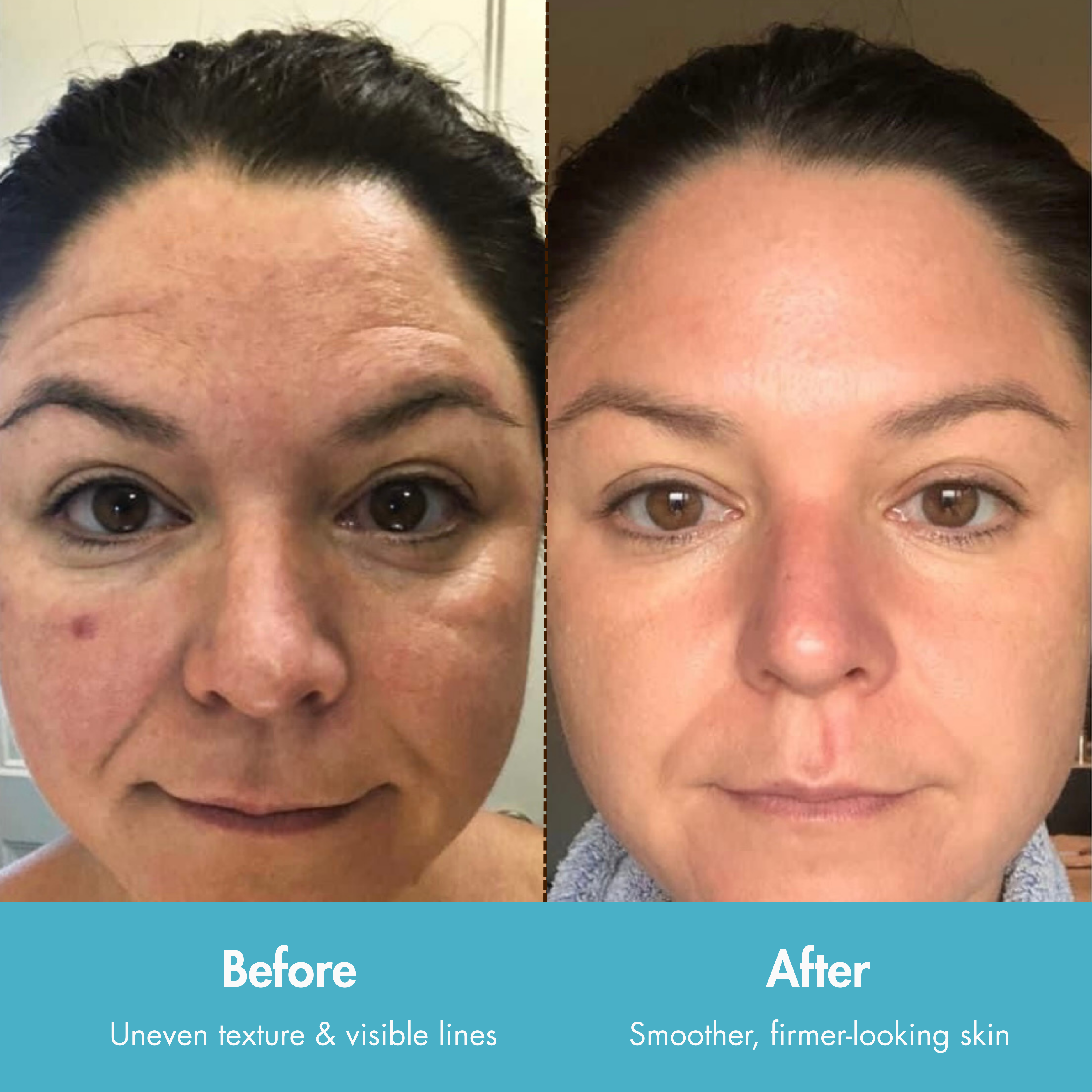 AlpaSkin™ Vita-A Retinal Shot