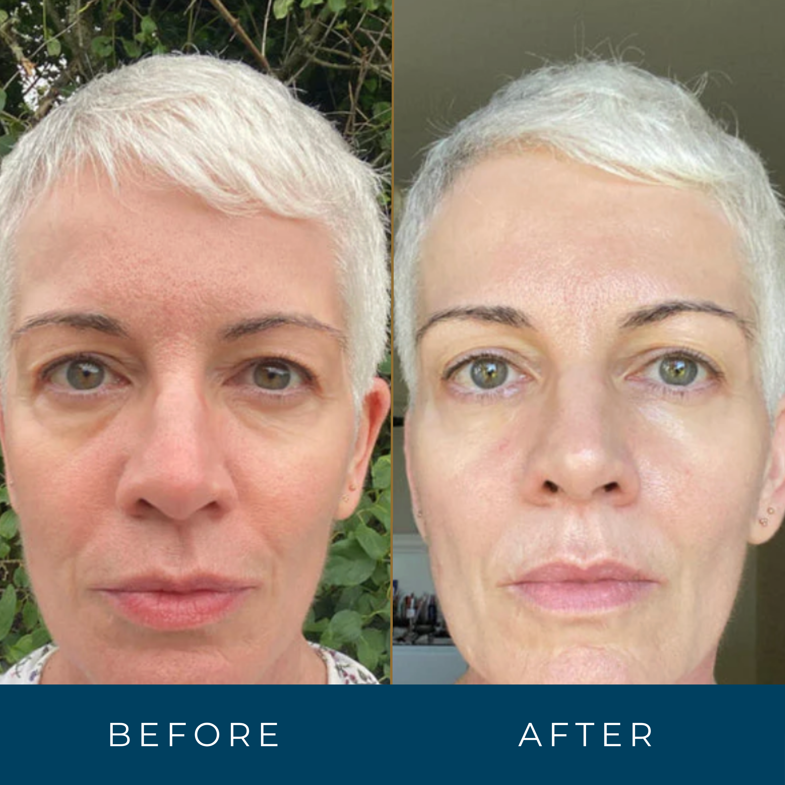 Retinal Face Serum Anti-Aging Vitamin A Wrinkle Reducer